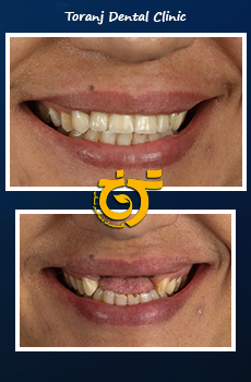 قبل و بعد از ایمپلنت دندان