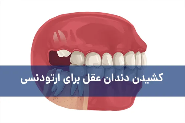 کشیدن دندان عقل برای ارتودنسی