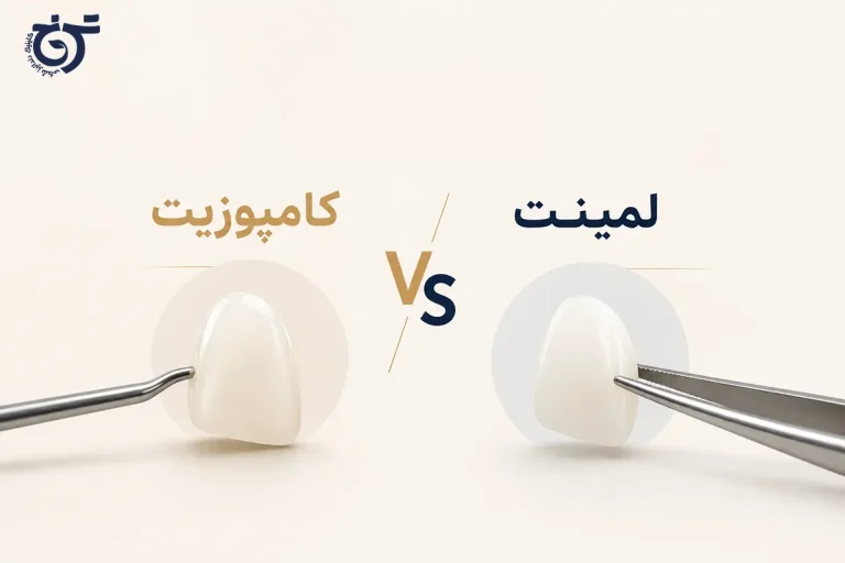 فرق لمینت و کامپوزیت