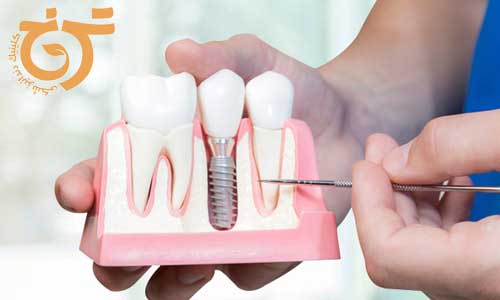 مزایای ایمپلنت نسبت به دندان مصنوعی