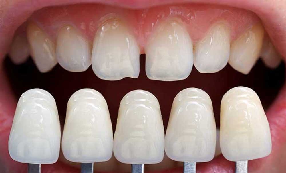 طول عمر لمینت های مختلف دندان