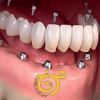 7 دسته از افرادی که نباید ایمپلنت دندان انجام بدهند
