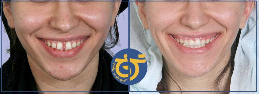قبل و بعد از اصلاح لبخند با ارتودنسی