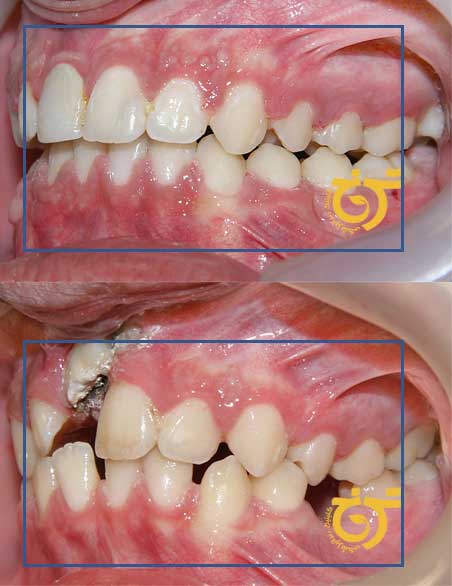 قبل و بعد از ارتودنسی در شرق تهران
