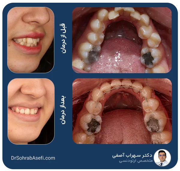 قبل و بعد درمان ارتودنسی با دکتر سهراب آصفی