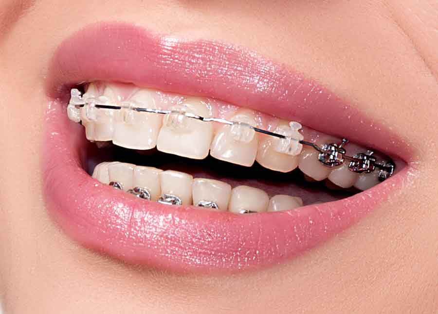 تصویر ارتودنسی دندان