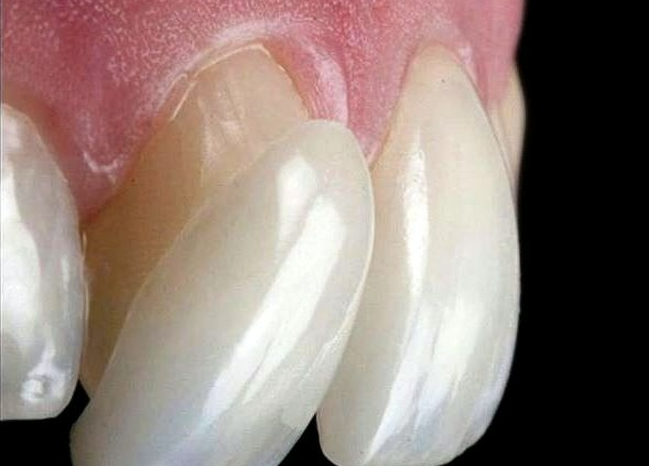 نمونه ای از لمینت دندان بدون تراش