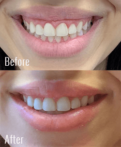 قبل و بعد از جراحی لبخند لثه ای