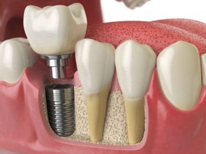 هزینه ایمپلنت دندان با بیمه