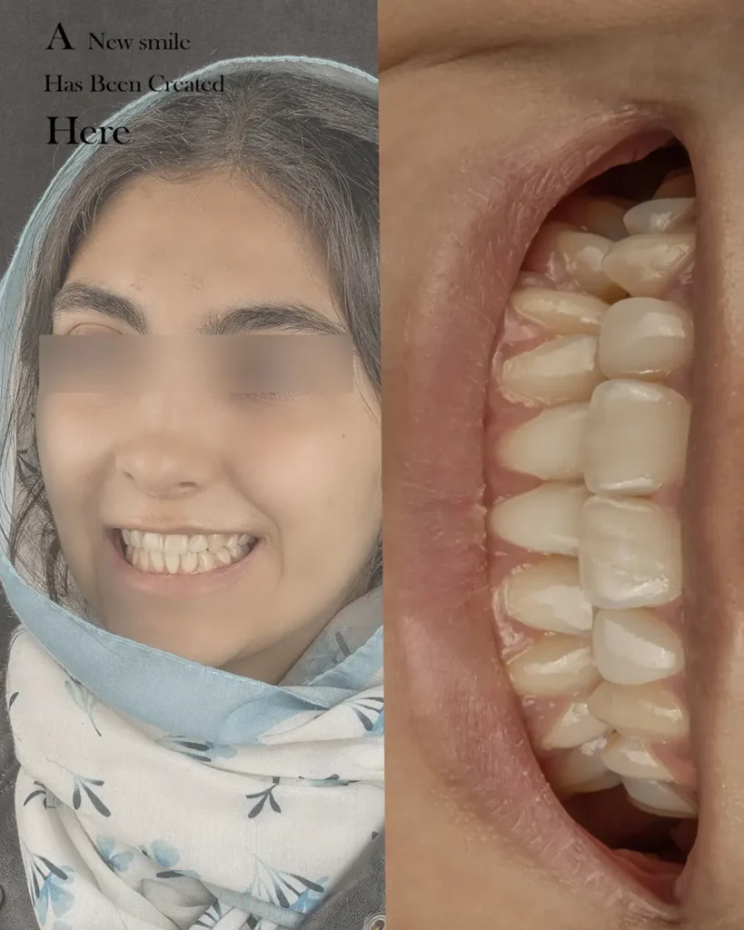 عکس قبل و بعد کامپوزیت ونیر دندان