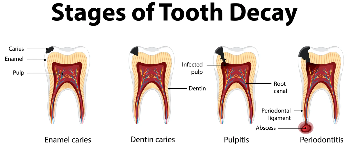 آبسه دندان چگونه بوجود می آید؟
