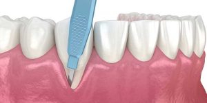 جراحی لثه برای روکش دندان