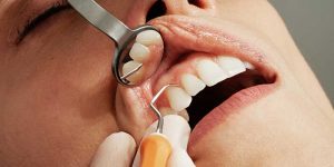 عفونت دندان در دندانپزشکی در بارداری