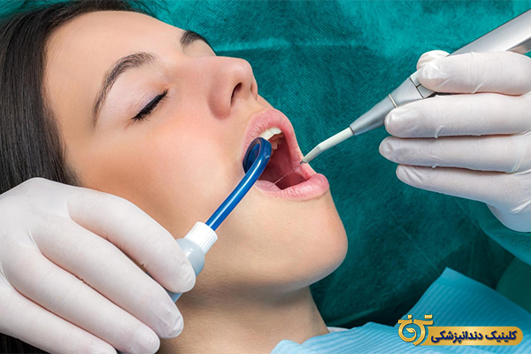 درمان کجی دندان با کامپوزیت