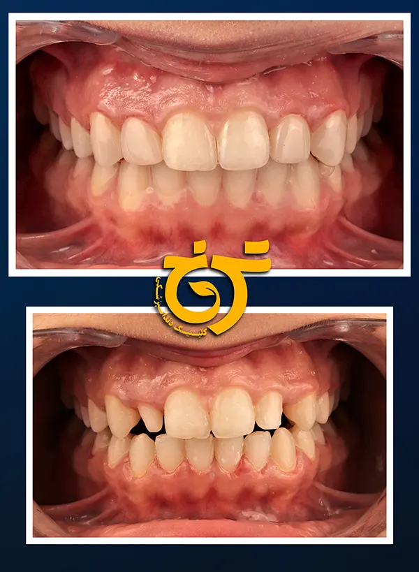 قبل و بعد کامپوزیت دندان در شرق تهران