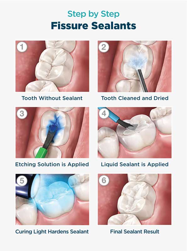 فیشور سیلانت برای جلوگیری از ایجاد پوسیدگی دندان‌