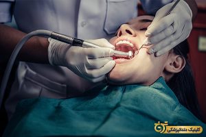 هزینه پر کردن دندان با کامپوزیت