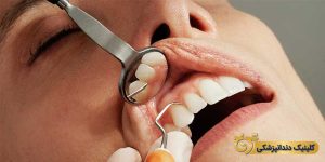 پوسیدگی دندان در دوران شیردهی