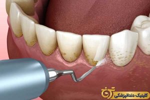 مراقبت های بعد از جرم گیری دندان