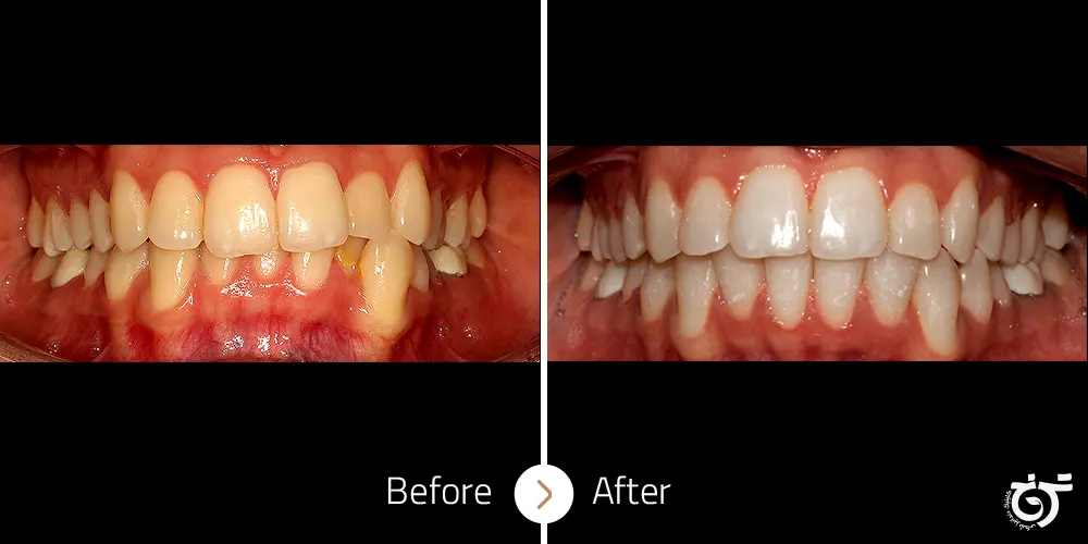 اصلاح کنت (کجی) فک بالا کراس بایت دندان ثنایای فک پایین توسط درمان ارتودنسی بدون کشیدن دندان