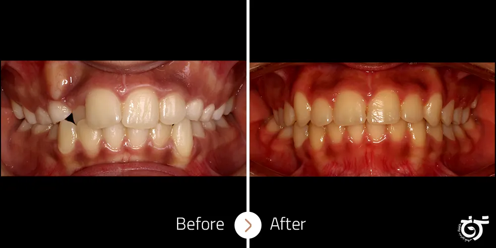 درمان بهم‌ریختگی شدید دندانی (بیرون‌زدگی دندان‌های نیش بالا و پایین) و کراس‌بایت دندان ثنایای طرفی بالا راست با ارتودنسی بدون کشیدن دندان دائمی