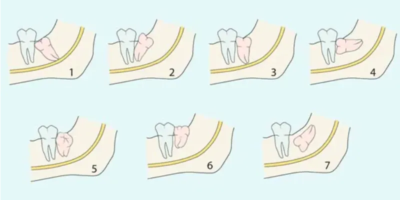 کشیدن دندان عقل برای ارتودنسی