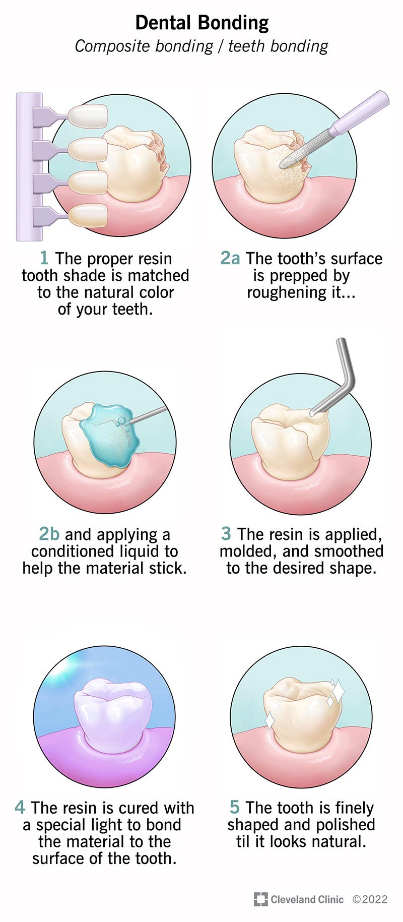 فرآیند باندینگ دندان