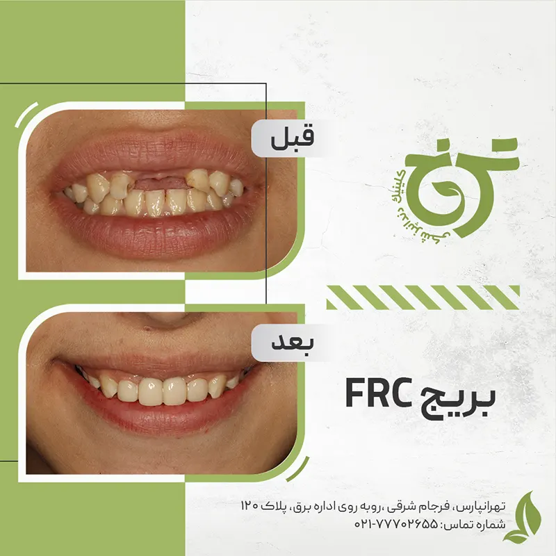 قبل و بعد درمان بریج دندان frc