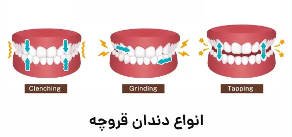 انواع دندان قروچه