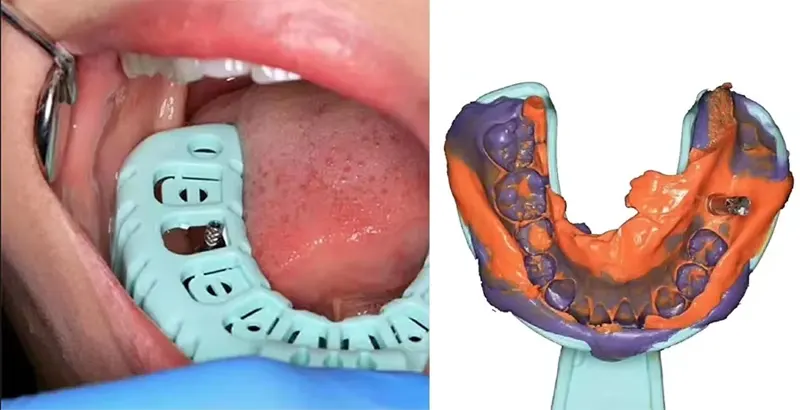 روش قالب گیری ایمپلنت دندان