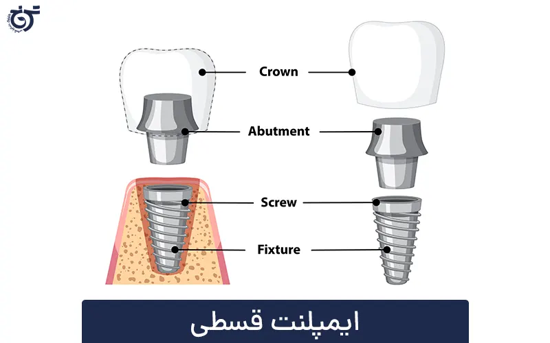 ایمپلنت قسطی در شرق تهران