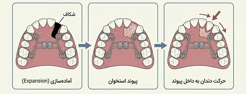 وسیعکنندهها (Expander) برای شکاف کام و لب