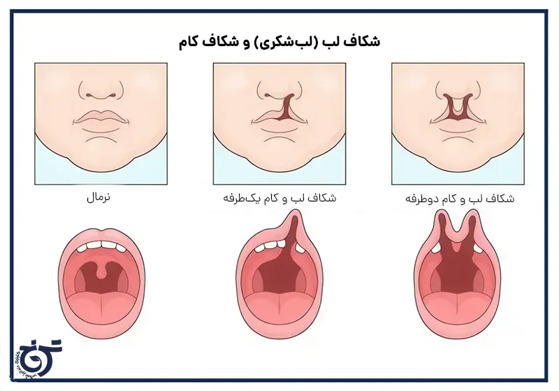 درمان شکاف کام و لب، لب شکری با ارتودنسی