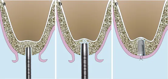 سینوس لیفت بسته (Closed Sinus Lift) یا روش Osteotome
