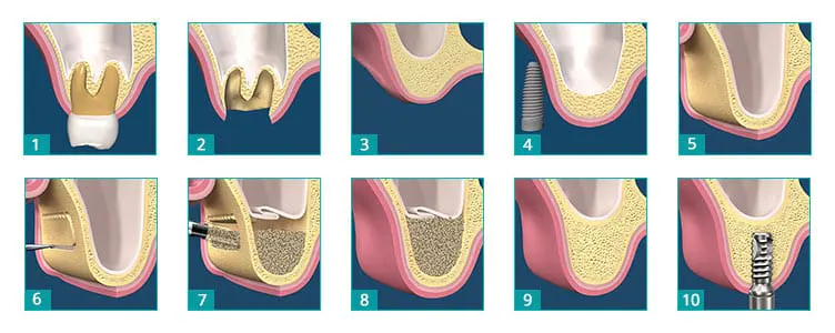 سینوس لیفت باز (Open Sinus Lift) یا روش Lateral