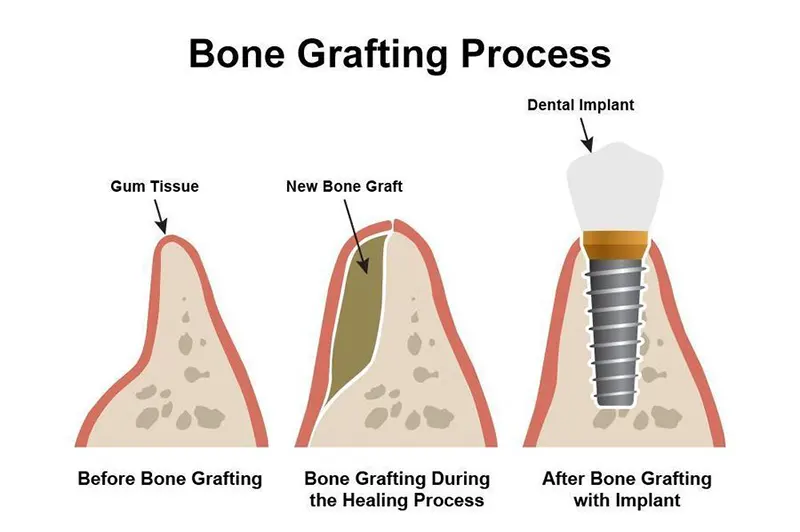 مواد پیوند استخوان (Bone Graft) مورد استفاده در جراحی
