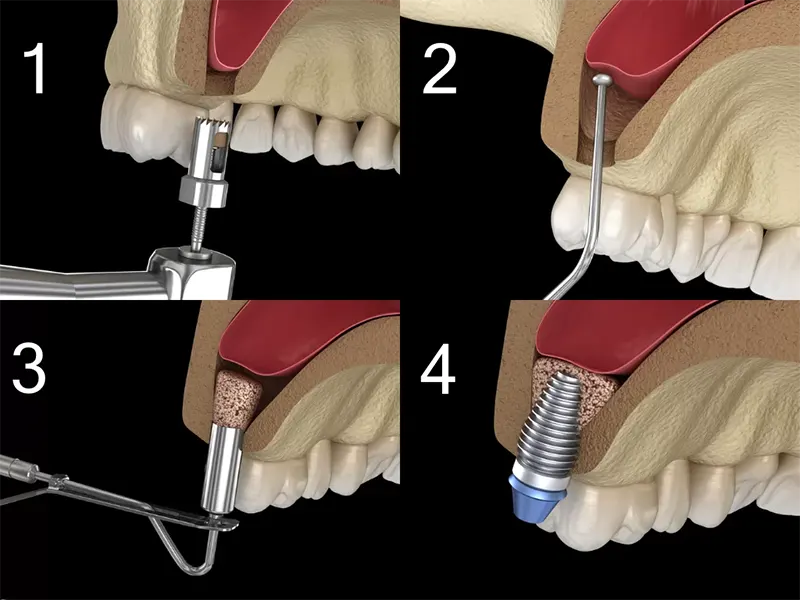 جراحی سینوس لیفت (Sinus Lift) چیست؟