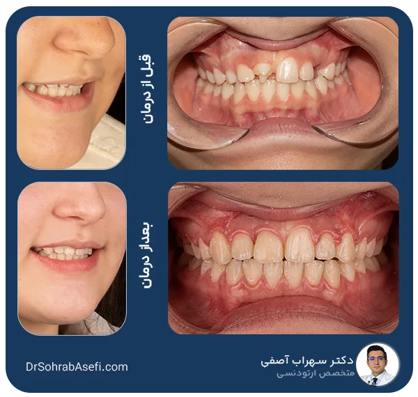 قبل و بعد درمان ارتودنسی | دکتر سهراب آصفی