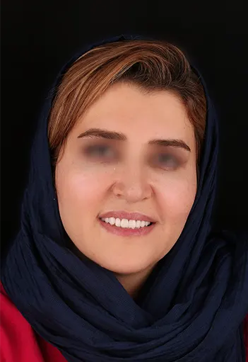 لمینت دندان