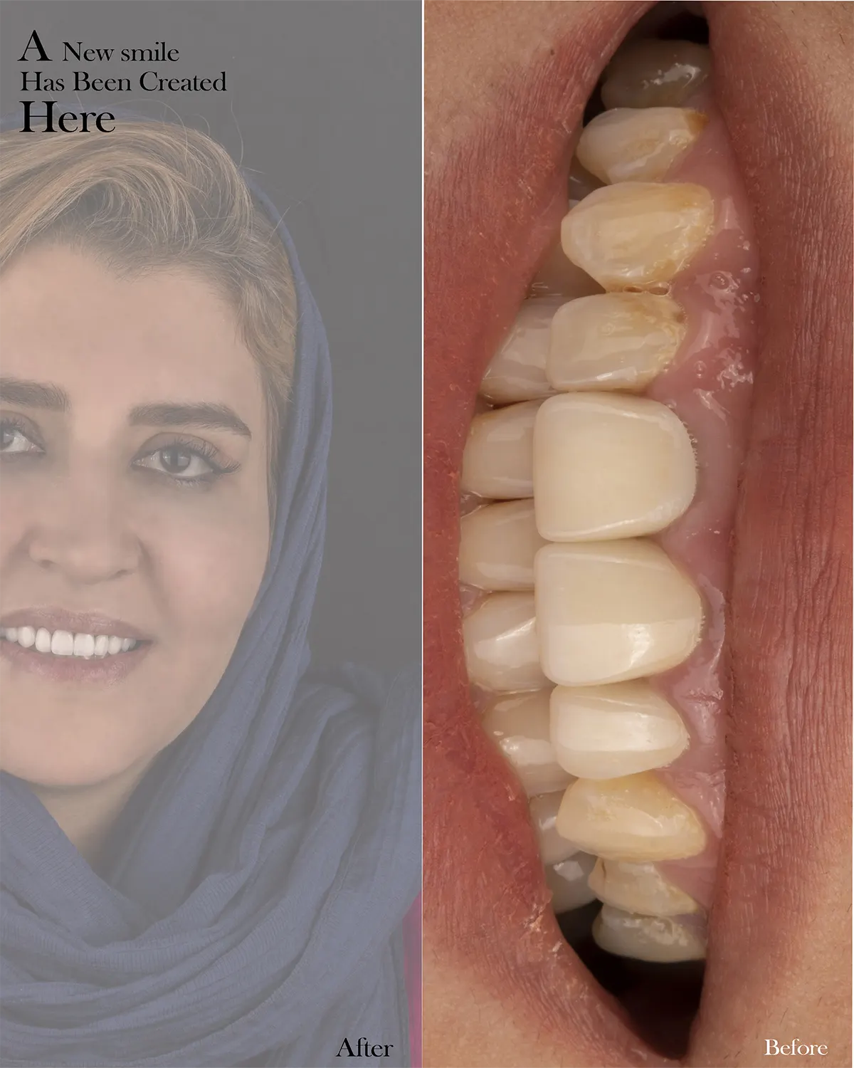 عکس قبل و بعد لمینت دندان