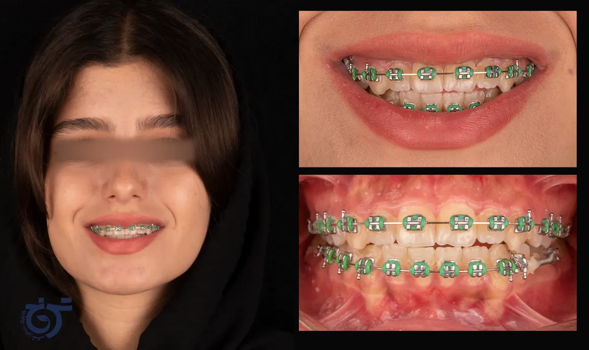 رنگ سبز ارتودنسی - ارتودنسی رنگی دخترانه