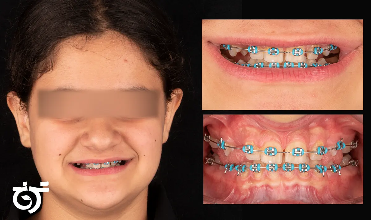 ارتودنسی رنگی دخترانه آبی فیروزه ای